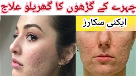 How To Get Rid Of Acne Scars Permanently Acne Scars Kaisa Khatam Karain Bestscars Treatment