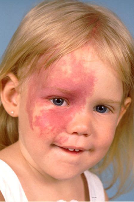 Image Result For Sturge Weber Syndrome Port Wine Stain Medical