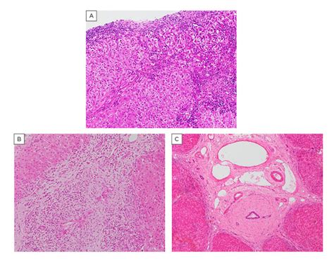 Overlap Syndrome With AIH And PSC EMJ Reviews