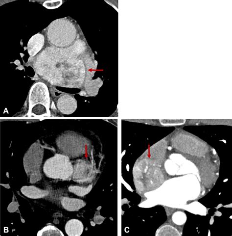 Multimodality Imaging Of Cardiac Paragangliomas Radiology