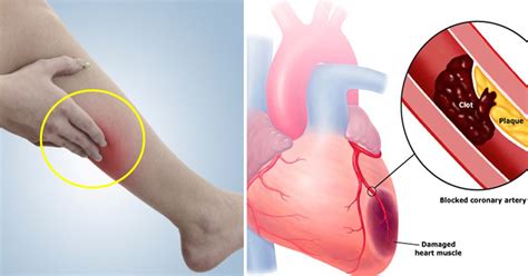 10 Signs Of Blood Clot