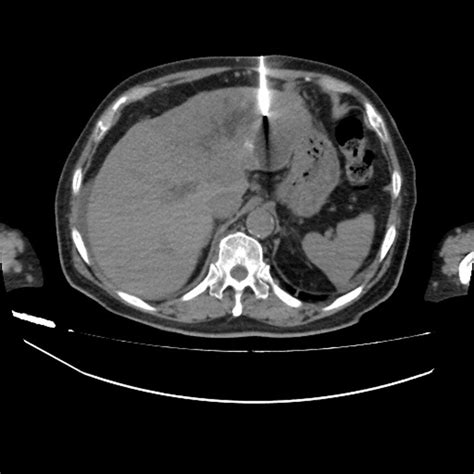 Ct Guided Needle Biopsy Download Scientific Diagram