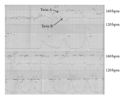 Fetal Heart Rate Tracings During The Active Phase Of Labor Showing The Download Scientific