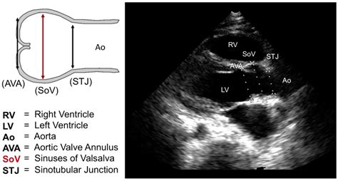 Anatomy Of Aortic Root