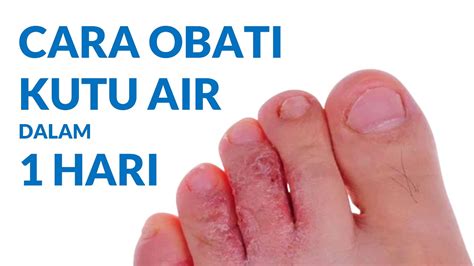 CARA MENGOBATI KUTU AIR DI KAKI DAN TANGAN YouTube