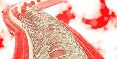 Stent Thrombosis May Be Presenting Feature of COVID-19 | tctmd.com