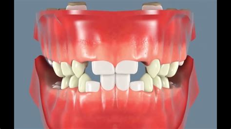 Évolution dentaire les dents de laits et définitives YouTube