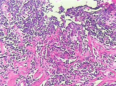 Biopsy Of Colon Demonstrated Necrotic Material With Cell Debris And