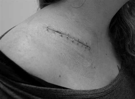 Clavicle Surgery -Update - Moto-Related - Motocross Forums / Message ...