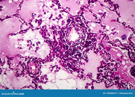 Adénocarcinome de poumon image stock Image du pathologie 130900447