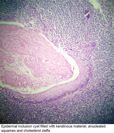 Inclusion Cyst Histology