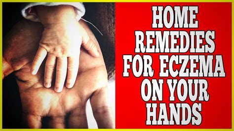 Home Remedies For Eczema On Hands 2 Easy Natural Home Remedies For