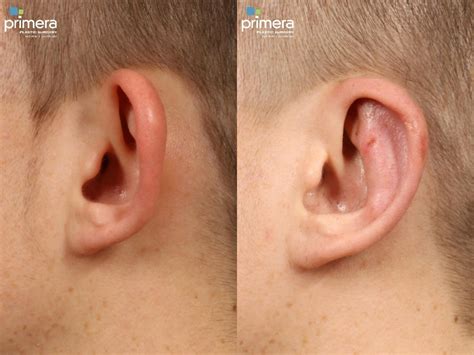 Ear Surgery Otoplasty Before And After Pictures Case 300 Orlando