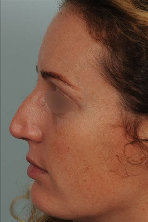 Photos De Rhinoplastie Avec Pointe Du Nez Trop Large Avant Et Apr S