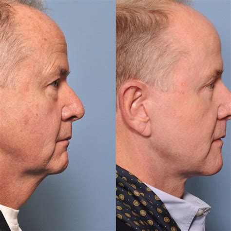 Preoperative And Postoperative Photos Of Male Facelift Patients With