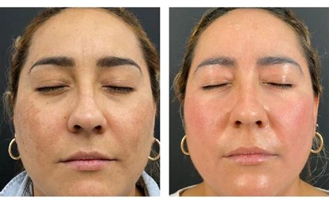 Peeling Antes Y Despu S Multiestetica Mx Multiestetica Mx