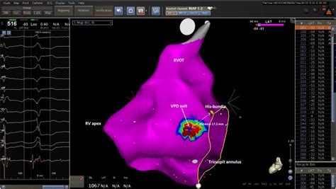 Successful Catheter Ablation Of Para Hisian Premature Ventricular