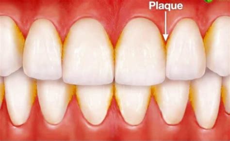 Plaque and calculus - Rawson Dental