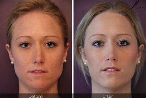 Facial Slimming Before and After at Facelove - Facelove