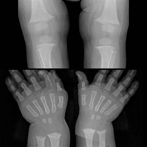 Hereditary Hypophosphatemic Rickets Pediatric Radiology Reference