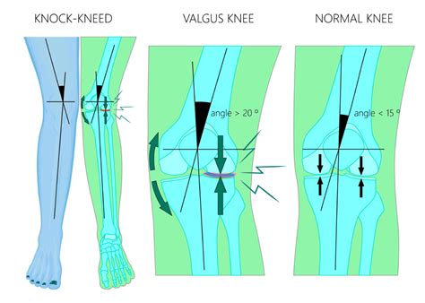 Distal Femoral Osteotomy Valgus Knee Malalignment Sugar Land