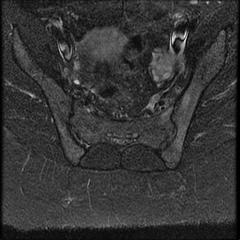 Acute Sacroiliitis Unilateral Image