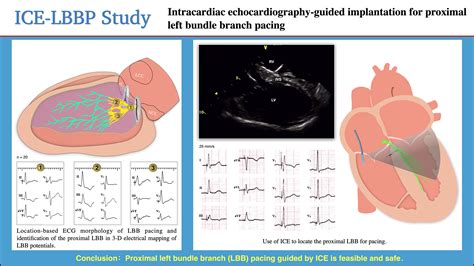 Intracardiac Echocardiographyguided Implantation For Proximal Left