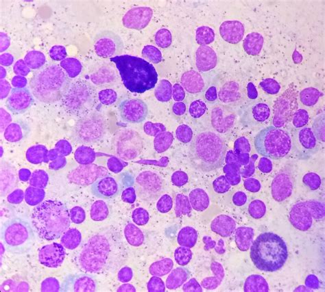 [figure Mast Cells Bone Marrow Aspirate ] Statpearls Ncbi Bookshelf