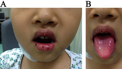 Clinical Signs Of Kawasaki Disease From The Perspective Of Epithelial