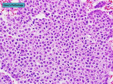 Qiaos Pathology Adult Granulosa Cell Tumor Of Ovary Flickr