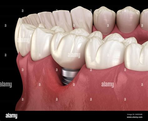 Peri Implant Mucositis Hi Res Stock Photography And Images Alamy