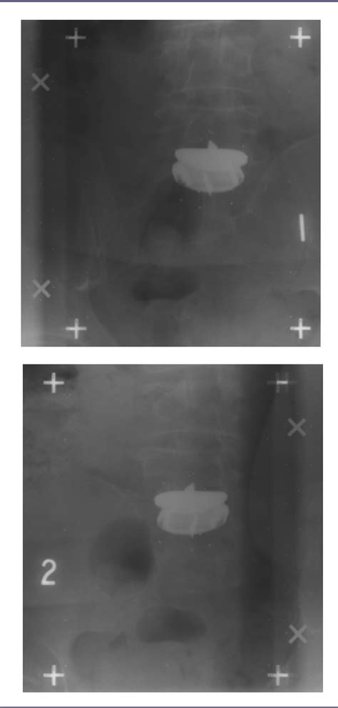 Figure From Radiostereometric Analysis Following Intervertebral Disc