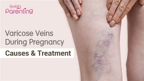 How To Deal With Varicose Veins During Pregnancy Youtube