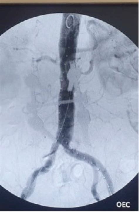 Preoperative Angiography In Anteroposterior Projection Download Scientific Diagram