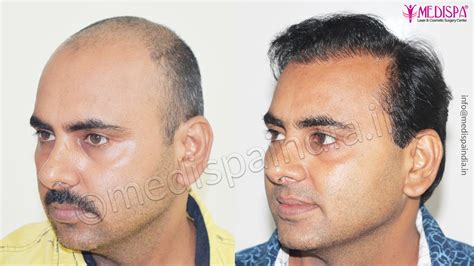 Faridabad Hair Transplant Result Hair Transplant Dubai Cost