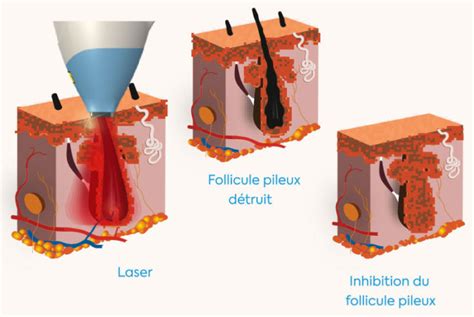 Épilation Définitive Insitu Laser