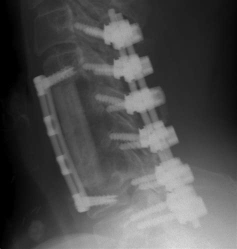 Complications Of Spinal Instrumentation Radiographics