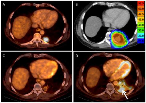 Complete Metabolic Response Displayed In A Colorectal Cancer Patient