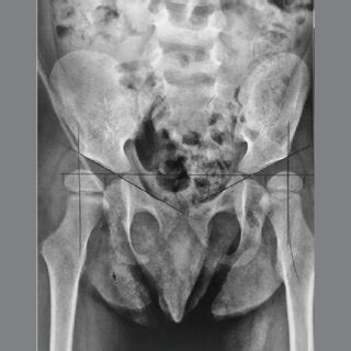 Anteroposterior Radiography Of The Pelvis With Migration Percentages Of