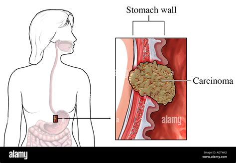 El Cáncer De Estómago Carcinoma Maligno Fotografía De Stock Alamy