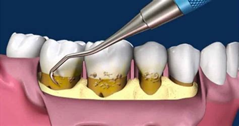 Cirugía Periodontal con Colgajo Solución Dental Lima Perú