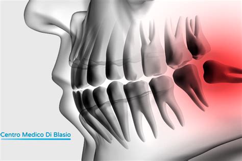 Estrazione Dente Del Giudizio Quando Necessaria Odontoiatria Parma