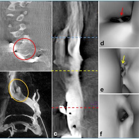 3d Rv Image Depicted Compression Of The Iliac Vein By The Posterior Download Scientific Diagram