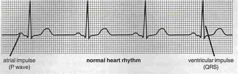 Sinus rhythm - wikidoc