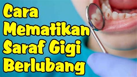 Cara Mematikan Saraf Gigi Berlubang Agar Tidak Sakit Dengan Mudah Youtube