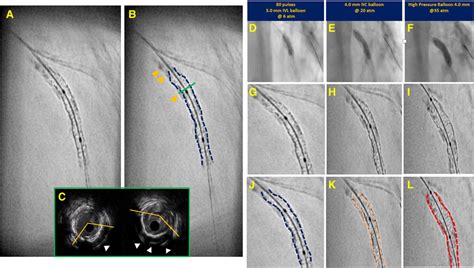 Case Example Of Calcified In Stent Restenosis Enhanced Angiography