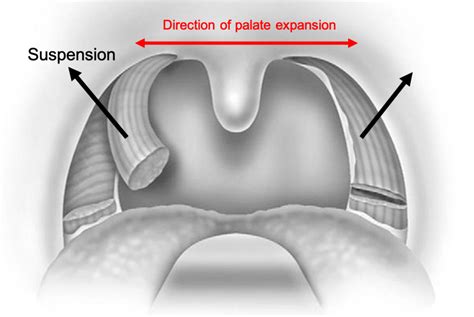 Throat Surgery - Voice and Sleep