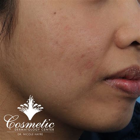 Microneedling Facial Treatment Cosmetic Dermatology Center