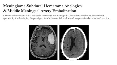 Meningioma Embolization Quantitative Insights And Implications For