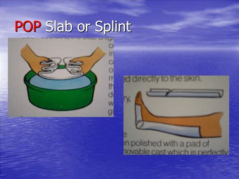 PPT Principles Of Fracture Treatment PowerPoint Presentation Free